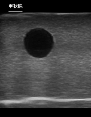 B-Ultrasound Teaching Abdomen Puncture Sampling Biospy Drainage ...